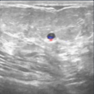 Ultrasound containing a benign tumor with relevance