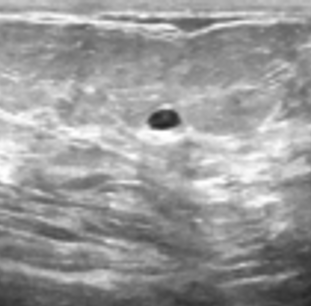 Ultrasound image containing a benign tumor