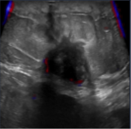 Ultrasound containing a malignant tumor with relevance