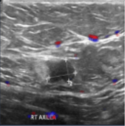 Relevance for ultrasound image containing a malignant tumor with text