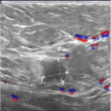 Relevance for ultrasound image containing a malignant tumor with text removed