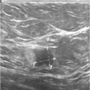 Ultrasound image containing a malignant tumor with text removed
