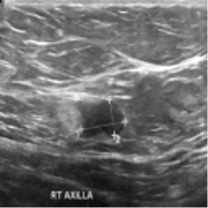 Ultrasound image containing a malignant tumor with text