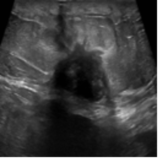 Ultrasound containing a malignant tumor
