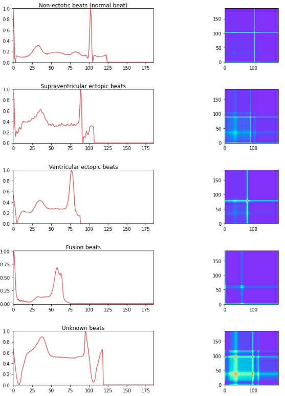 arrhythmia time series transformation using gaf