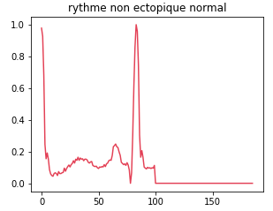 normal non ectopic rhythm
