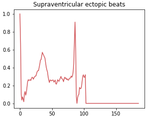 supraventricular ectopic rhythm